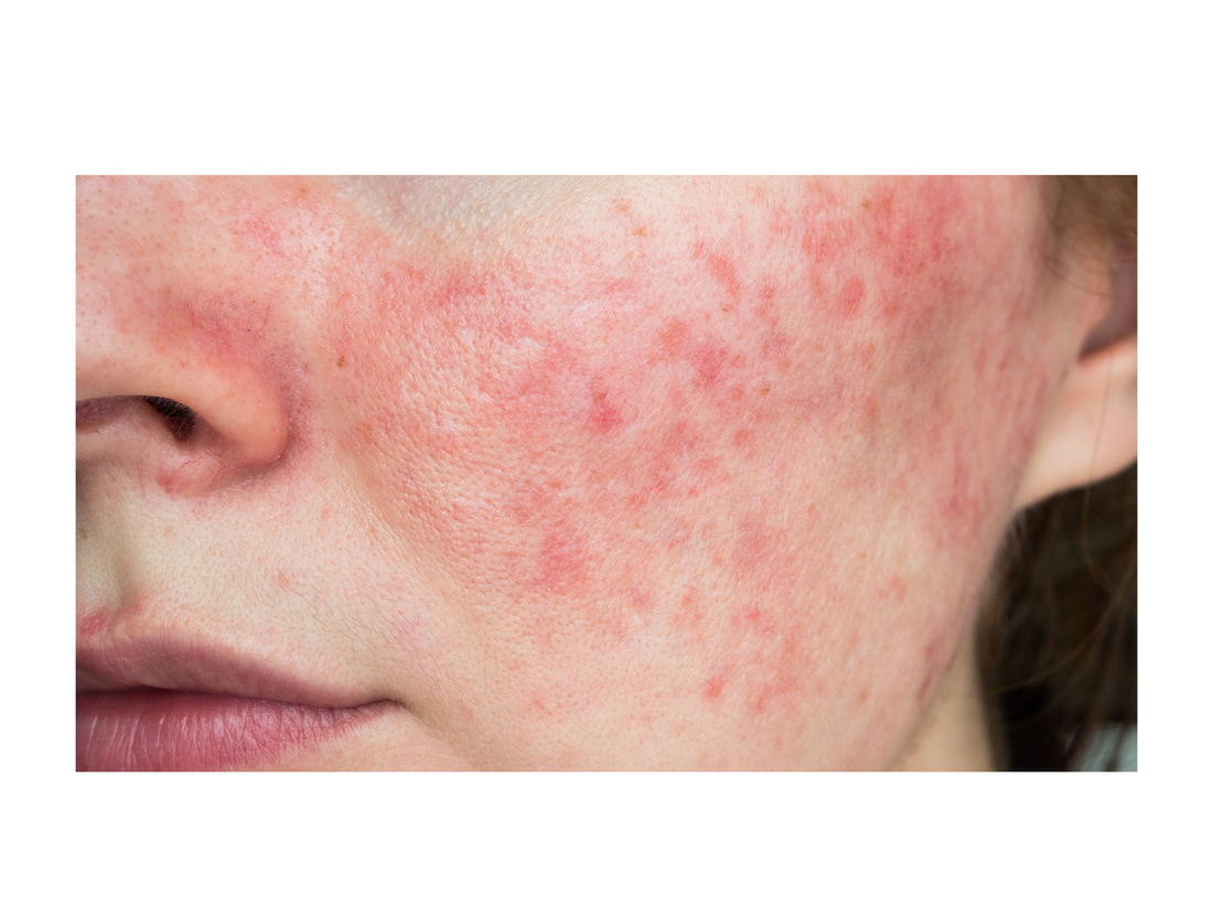 Demodex folliculorum and Rosacea: What You Need to Know