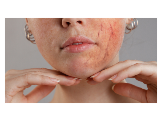 Rosacea and the Vascular System: How They Are Connected