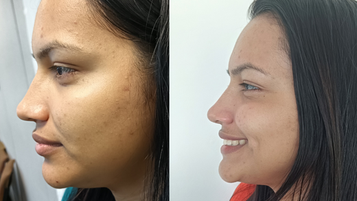 Before starting the treatment, Mariannys reported having dry skin marked by multiple pimples, which affected her self-esteem and confidence.