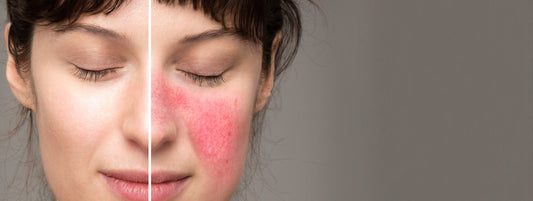 Rosacea: Key Symptoms and How to Identify Them