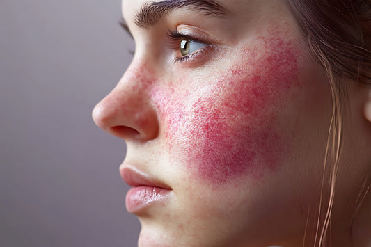 What is Rosacea?